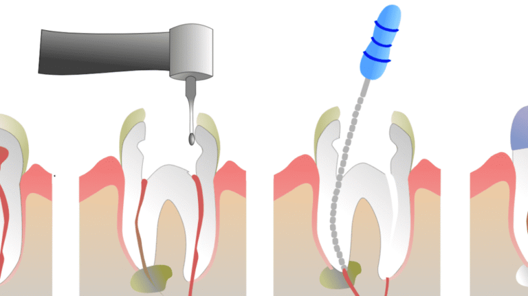 Fast Canals A Fast, Comfortable Root Canal Procedure: Step by Step - Glen B ...